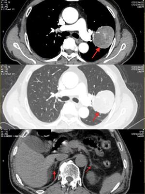 Nonfunctional ectopic adrenocortical carcinoma in the lung: A case report and literature review